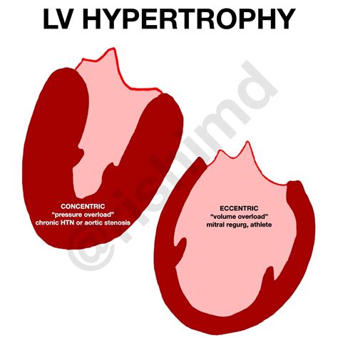 concentric vs eccentric hypertrophy